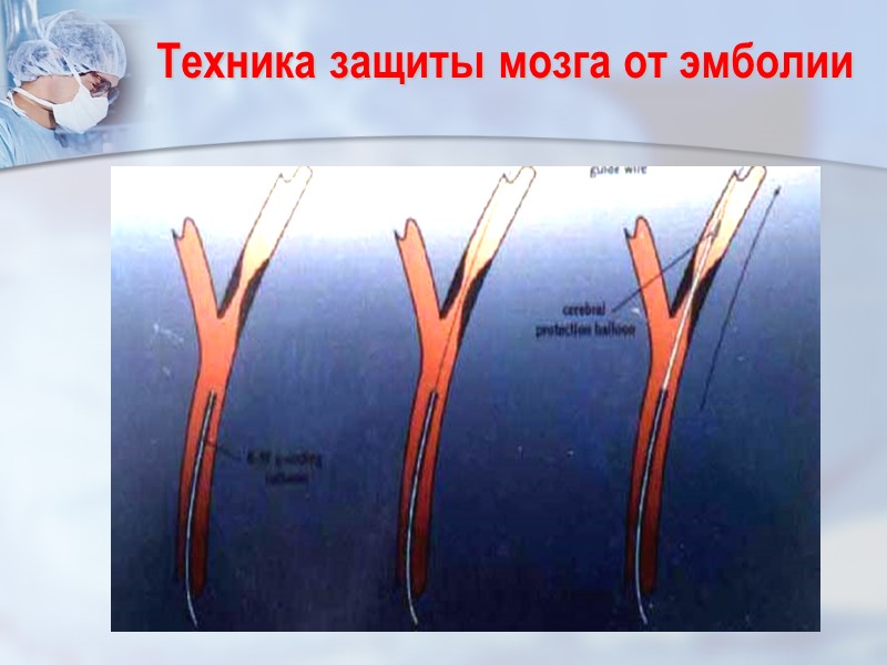 Техника защиты мозга от эмболии